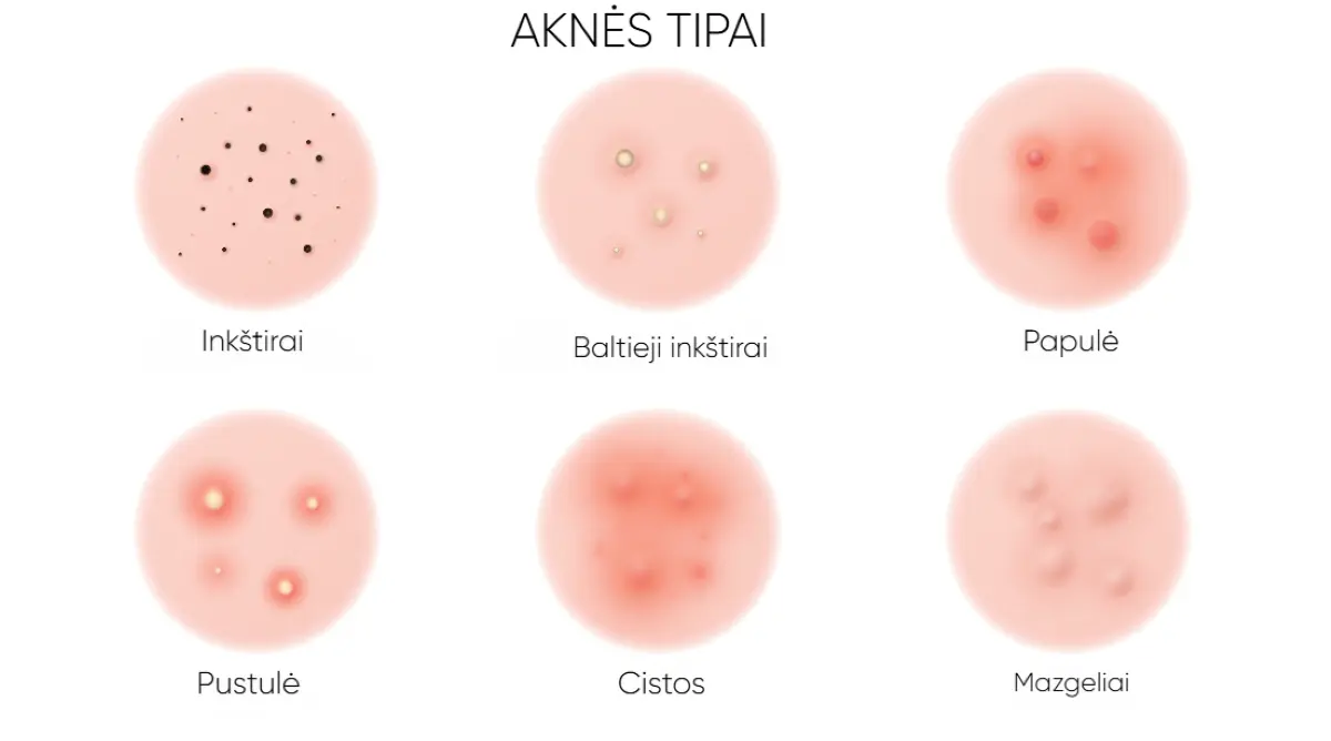 Aknės_tipai Aknės tipai