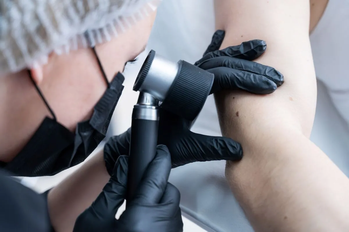 Dermatoskopija Dermatoskopija