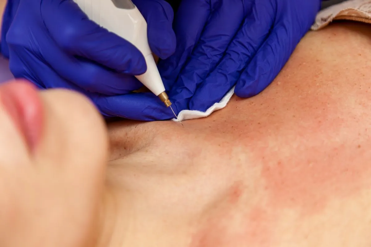 Papilomų_šalinimas_Kaune Papilomų šalinimas Kaune