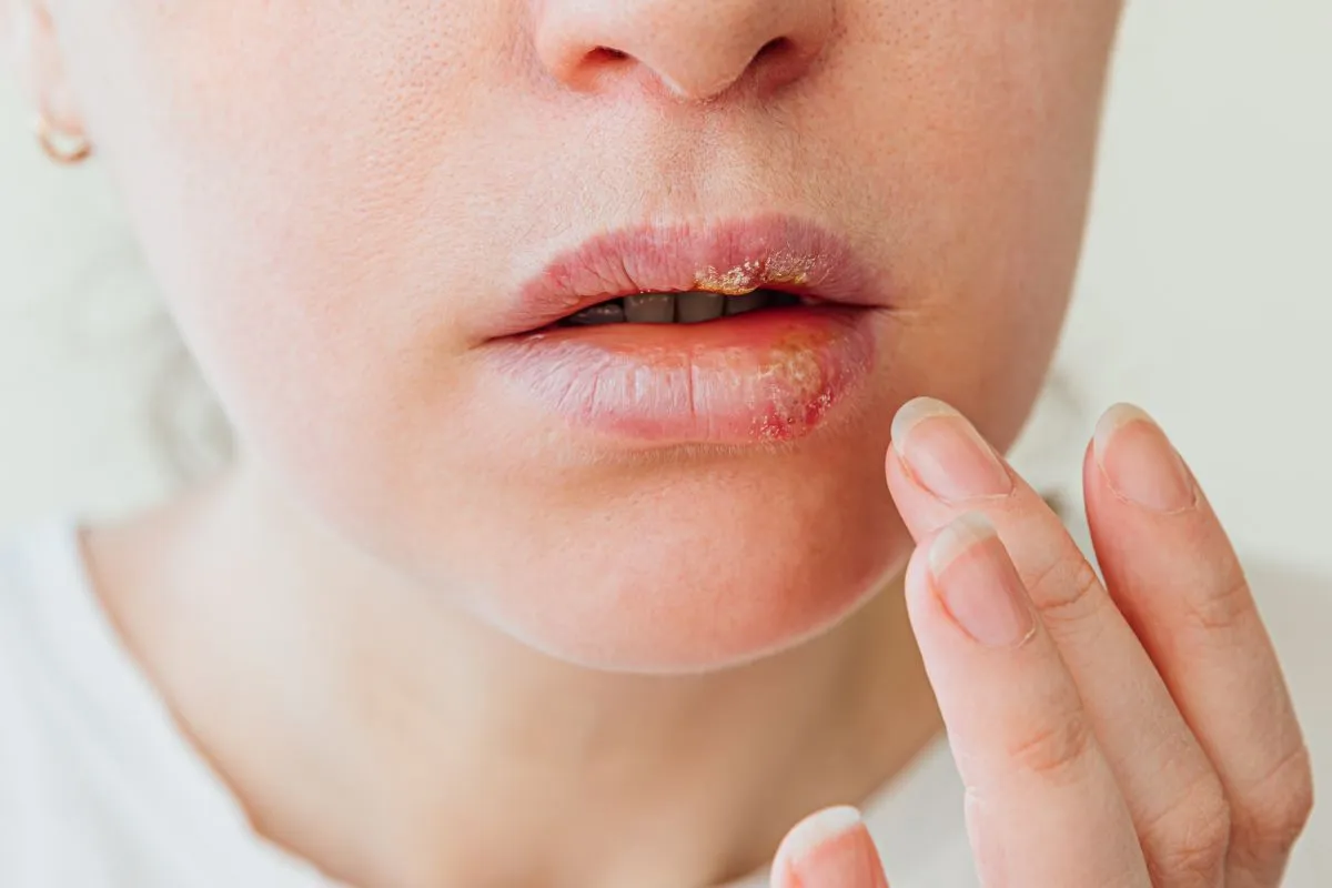 Herpes infekcija