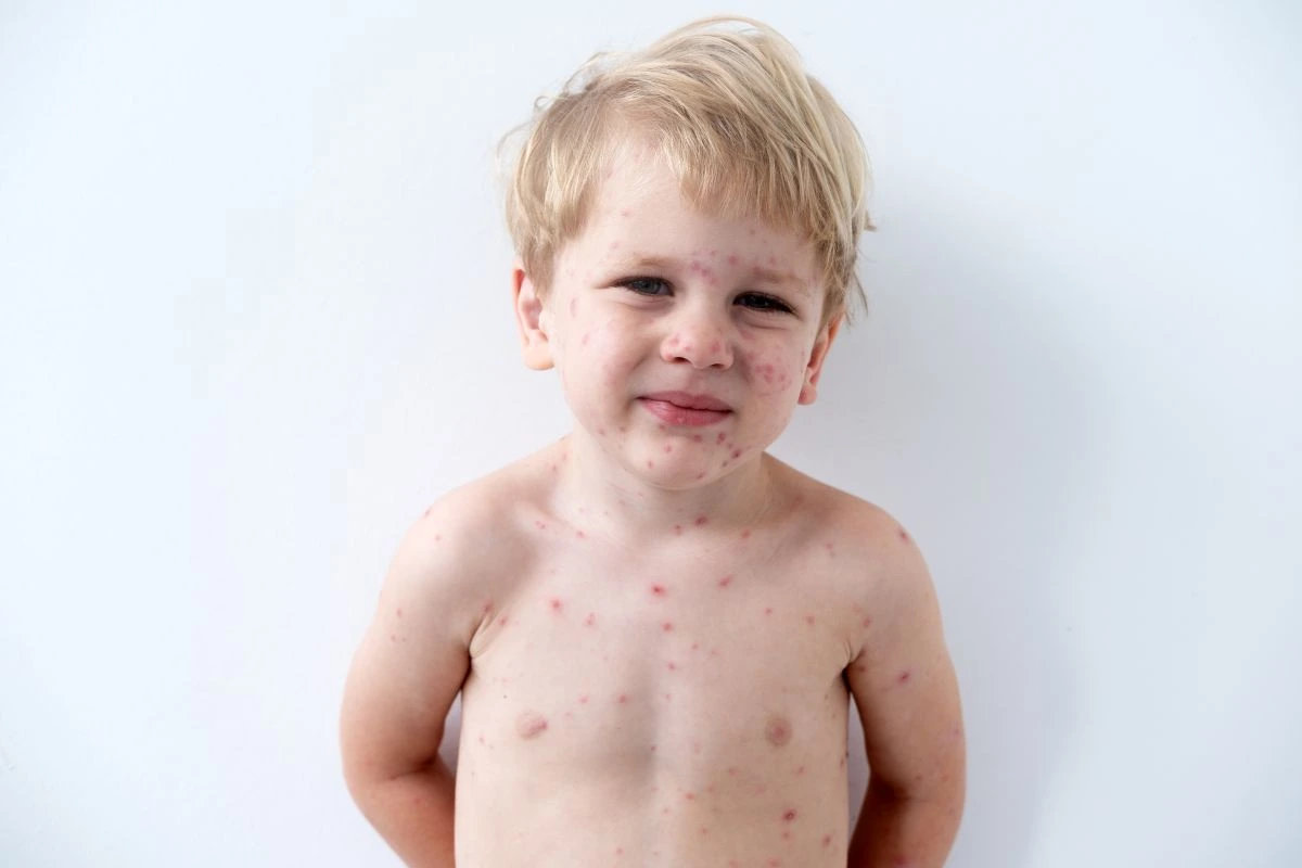 Vėjaraupių_gydymas Vėjaraupių gydymas