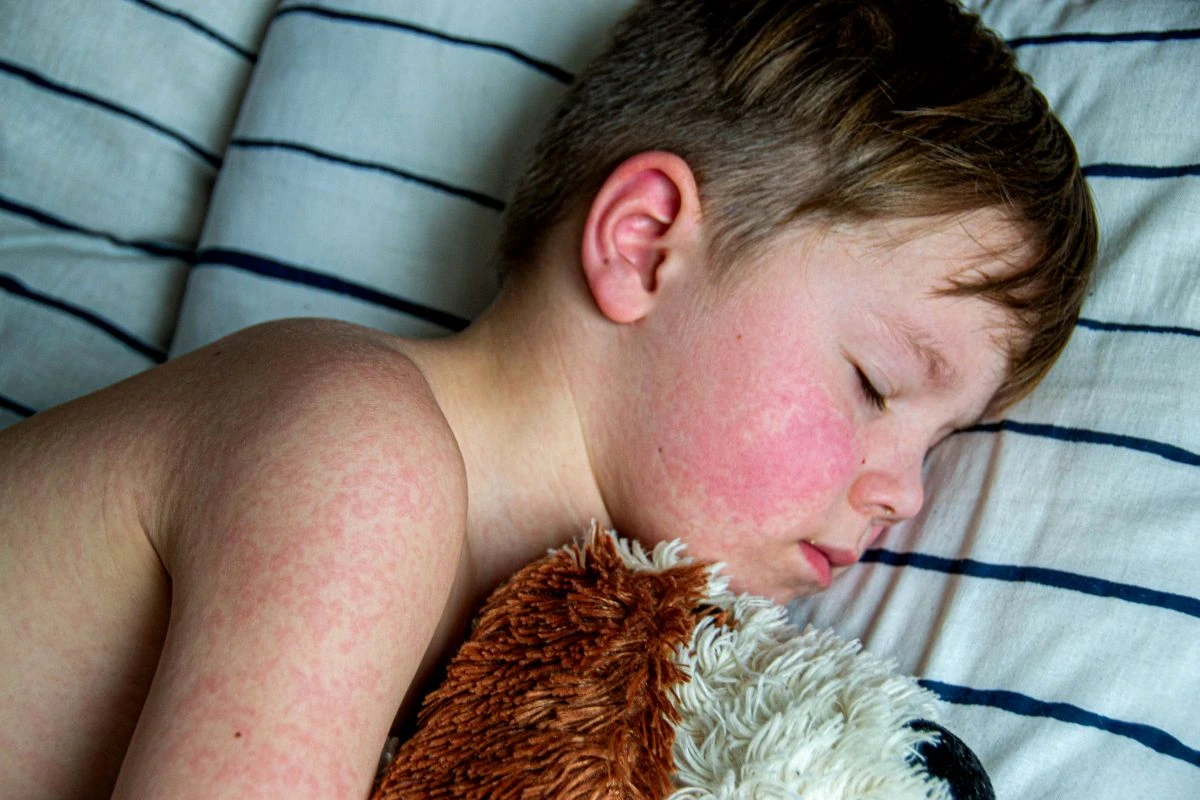 raudonukė raudonukė