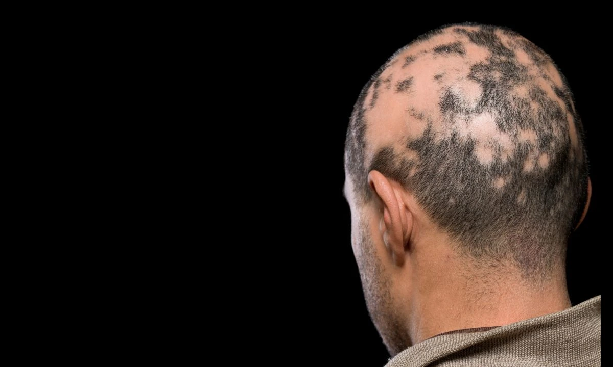 alopecija alopecija