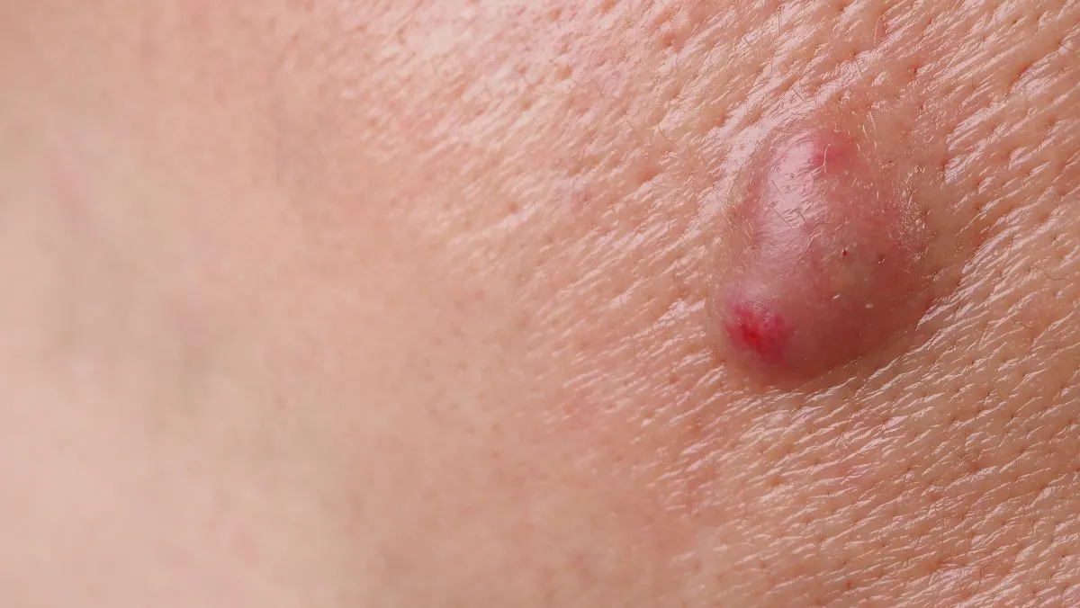 folikulinio_absceso_gydymas folikuliknio absceso gydymas