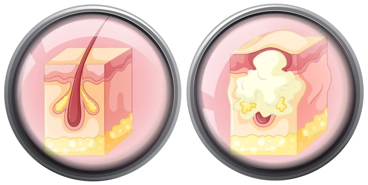 folikulinis_abscesas folikulinis abscesas