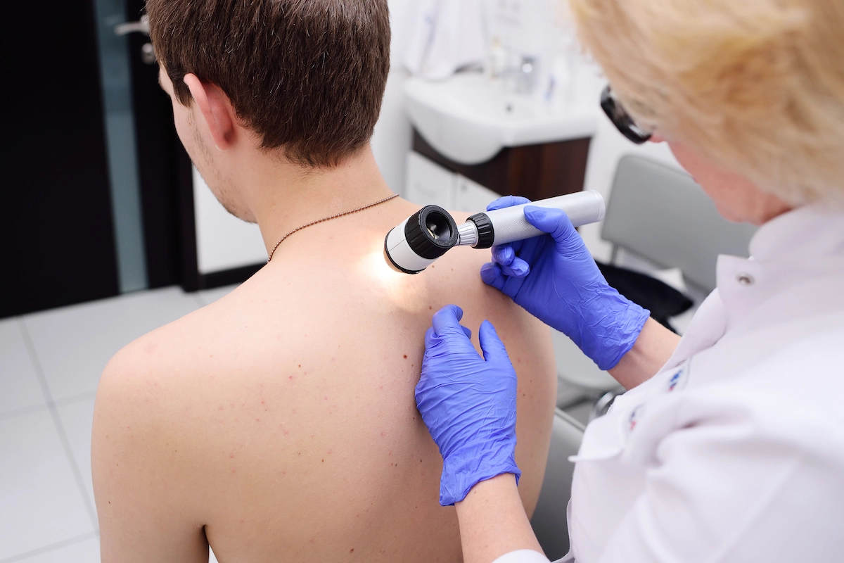 dermatoskopija